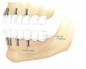 dental-implants-1 (1)