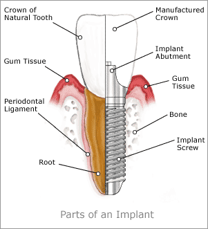 dental-implants-2 (1)