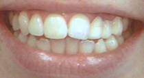 Los Angeles Cosmetic Veneers