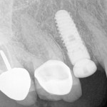 dental-implants-1-150x150