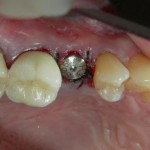 dental-implants-2-150x150