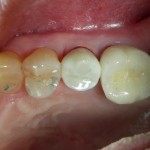 dental-implants-3-150x150