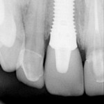 dental-implant-dentist-1-150x150