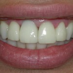 dental-implants-in-Los-Angeles-1-150x150