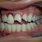 dental-implants-in-Los-Angeles-2-150x150