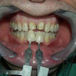 dental-veneers-150x150 (2)