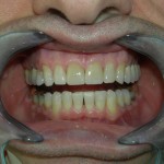 dental-veneers-Los-Angeles-150x150 (1)