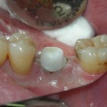 Dental-Implant-Dentist-Los-Angeles-150x150