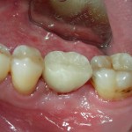 Dental-Implants-Los-Angeles-150x150