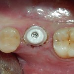 Los-Angeles-Dental-Implants-150x150 (2)