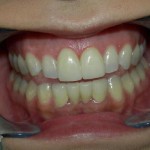 los-angeles-dental-veneers1-150x150