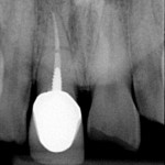 Dental-Implants-Dr-Arthur-A.-Kezian-DDS-150x150