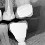 Dental-implants--150x150