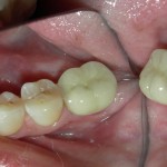 los-Angeles-dental-implants-150x150 (1)