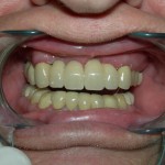 Los-Angeles-Dental-Implants-150x150