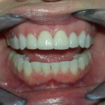 Porcelain-Veneers-Dr-Arthur-A-Kezian-DDS-150x150