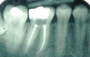 Root-Canal-Dentist-in-Los-Angeles2