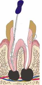 root canal dentist