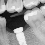 Dental-Implants-150x150