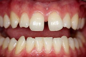 Getting Rid Of Diastemas Through Cosmetic Dentistry