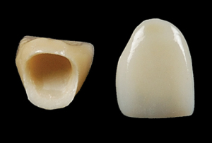 Porcelain Crowns