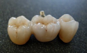 Dental-Bridge-300x183