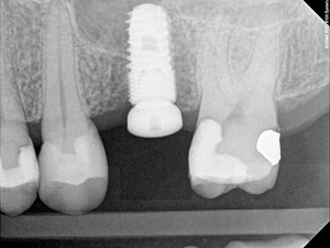 Dental-Implant-Dentist-300x225