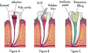 root-canal-treatment-1