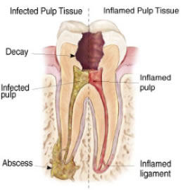 root-canal-treatment-2