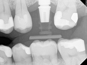 Dental-Implants-300x225 (1)