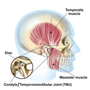 TMJ Disorder