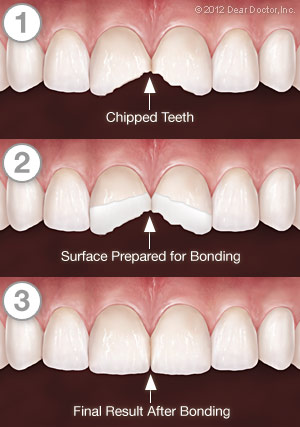 How to Fix a Broken Tooth - Channo DDS