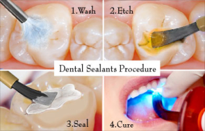 Dental Sealants