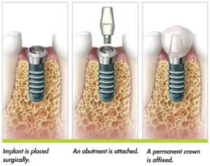 Dental Implant