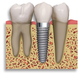 Implant Dentist in Los Angeles