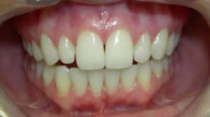 Cost of Dental Veneers