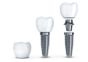 Dental Implants