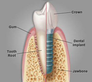 Dental Implants