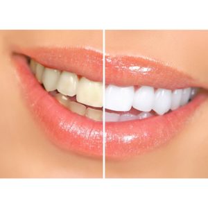 Teeth Whitening