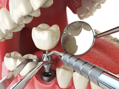 Implant Dentist in Los Angeles