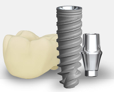 Implant Dentist in Los Angeles