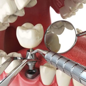 Dental Implants