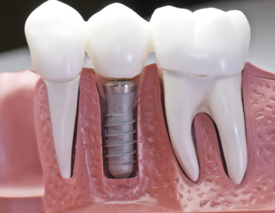 Implant Dentist in Los Angeles