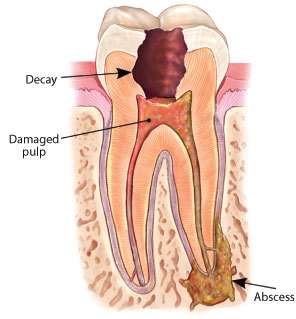 Root Canal