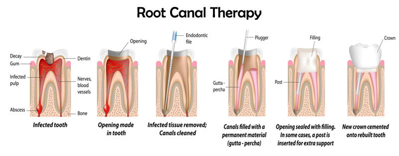 Root Canal