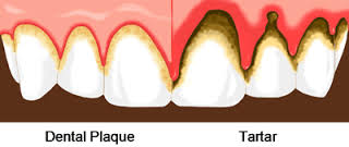 Dental Cleanings