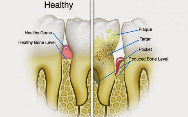 Dental Cleanings