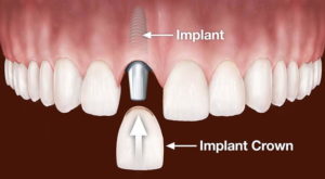 Implant Dentist